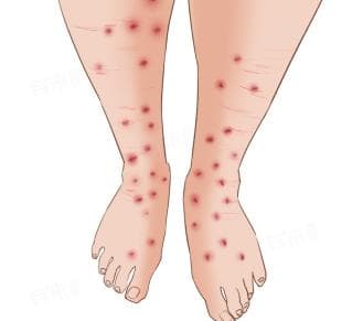 跳蚤咬的红疙瘩：症状、治疗与预防全攻略