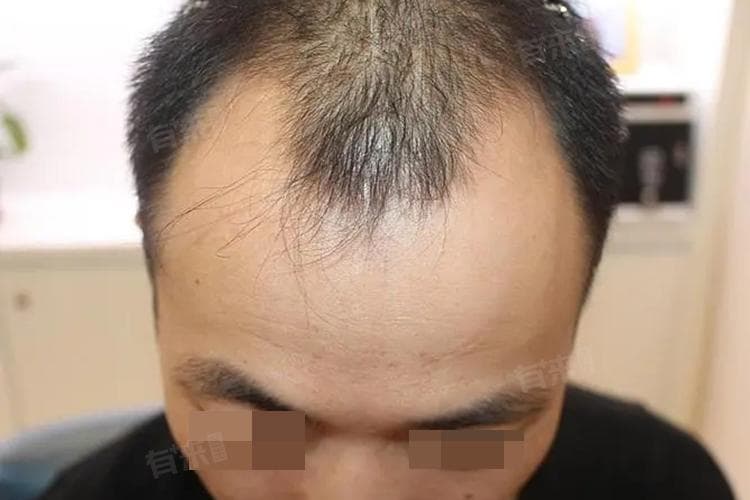 发际线怎样算高？全方位解析及改善方案