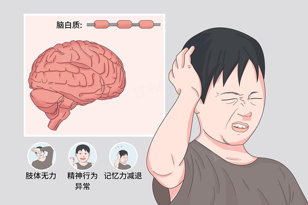 脑白质：大脑信号传输中枢，病变可致严重后果
