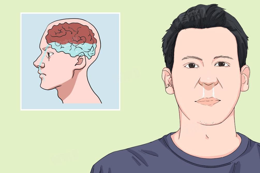 脑髓液从鼻子流出来严重吗