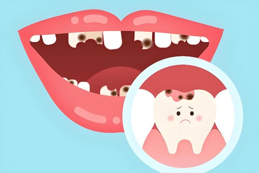 牙病 “常客”——龋齿，你真的了解它是什么吗？（上）