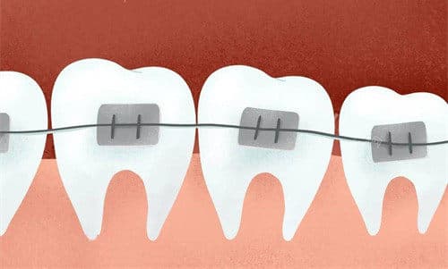 牙套钢丝移位怎么办？专业牙医提供实用解决方案