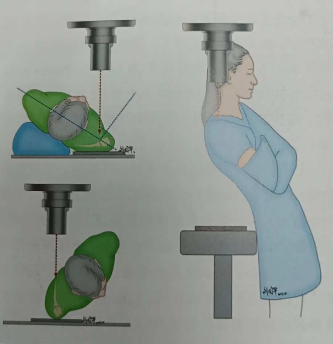 一文掌握！肱骨近端骨折：影像学、分型、治疗选择及并发症