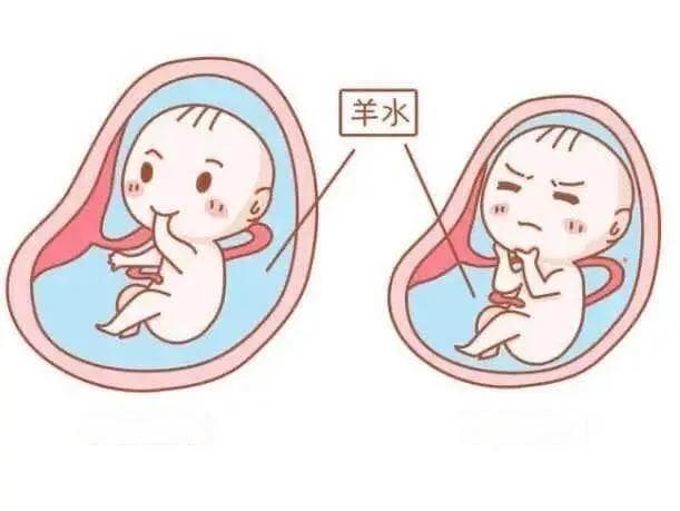 专家科普：孕妈产检发现羊水少紧急住院