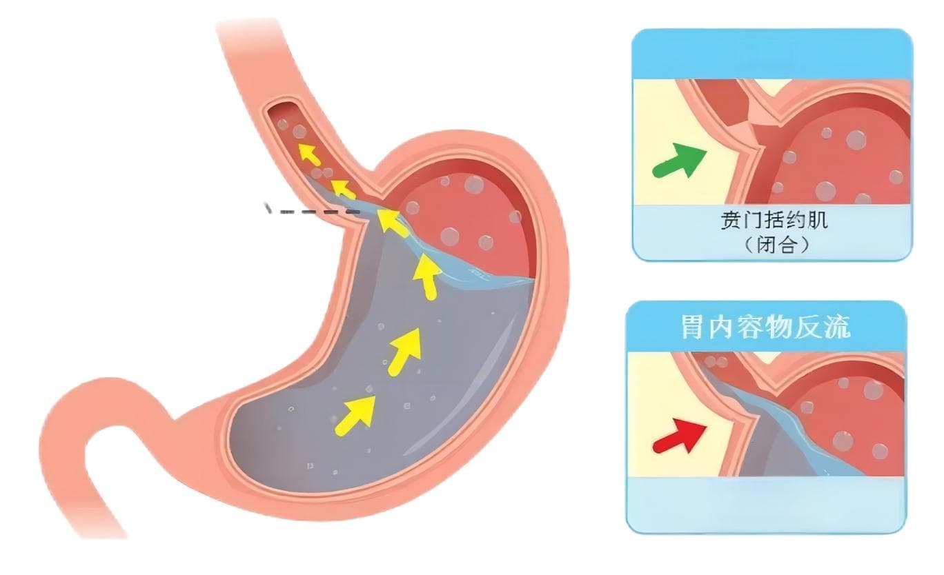 告别食管灼烧  探索反流性食管炎的根源与防治策略