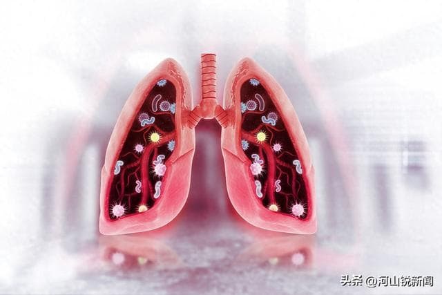 医生提醒：肺癌早期不是咳嗽，而是身上有这6大异常，千万别忽视