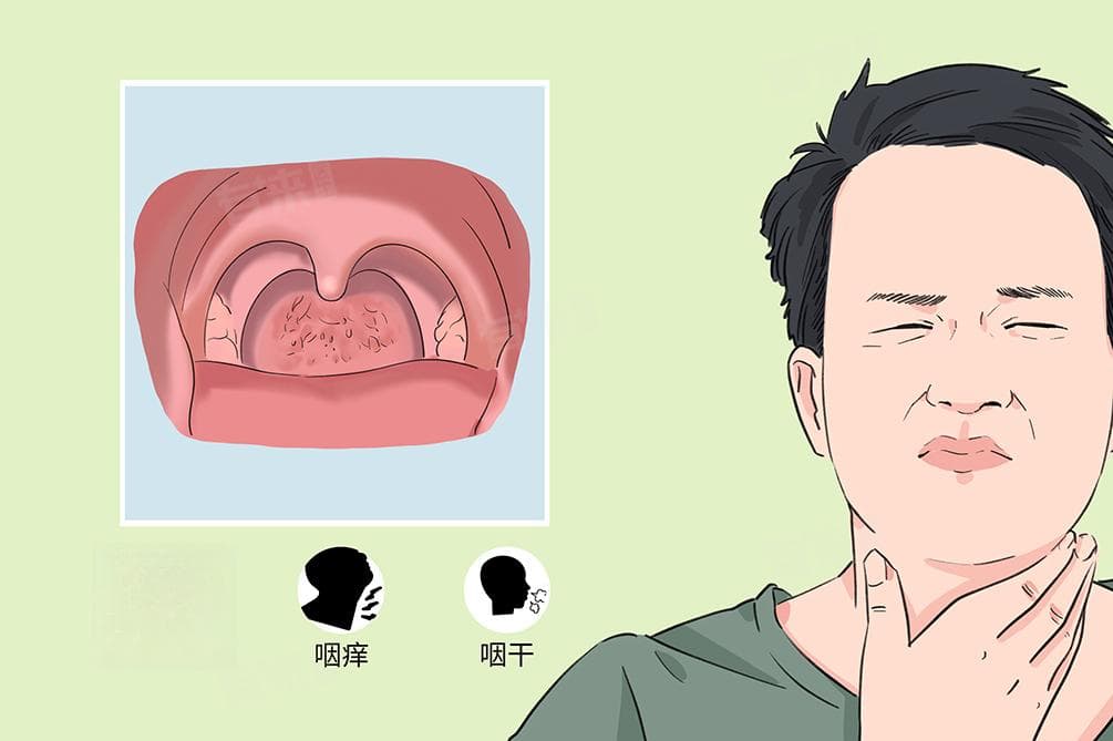 咳嗽痰多粘稠吐不完喉咙粘粘的怎么办