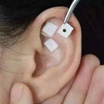 中医治疗之“耳穴”疗法
