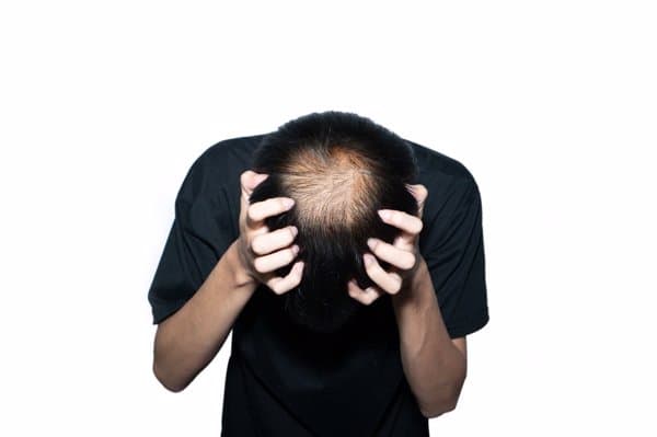 男性脱发查激素六项能查出什么
