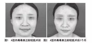 【罕见病例】A型肉毒毒素注射咬肌引起颞部凹陷