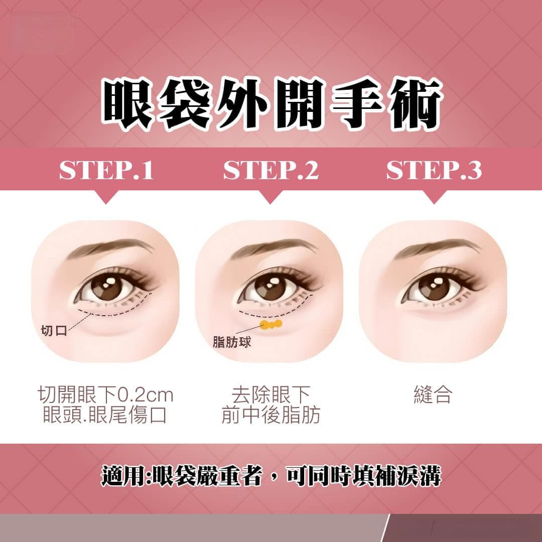 改善眼袋问题：玻尿酸与手术哪种方式比较有效