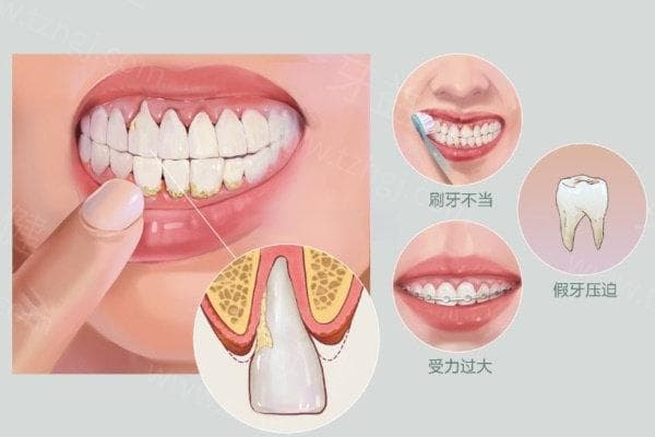 牙龈萎缩早期和晚期的图片对比