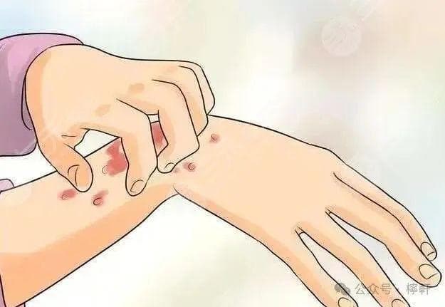 药物性皮炎小知识