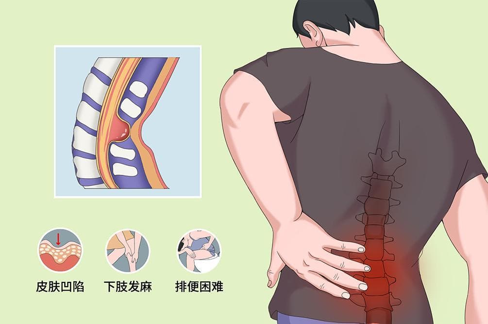 隐性脊柱裂