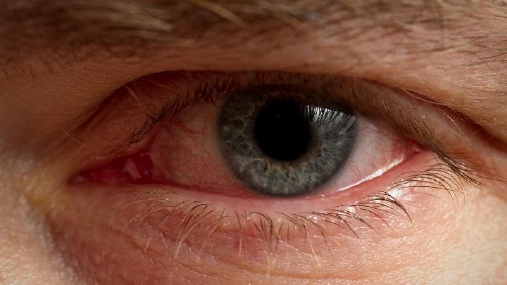 怎么判断是不是红眼病