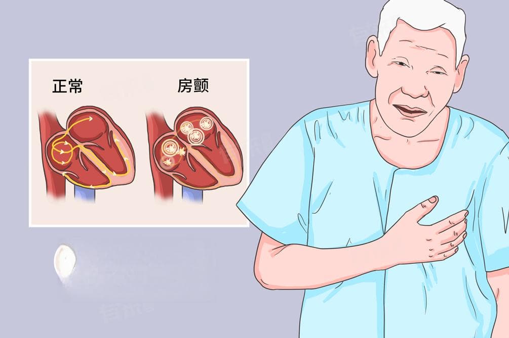 心房纤颤原因及治疗方法
