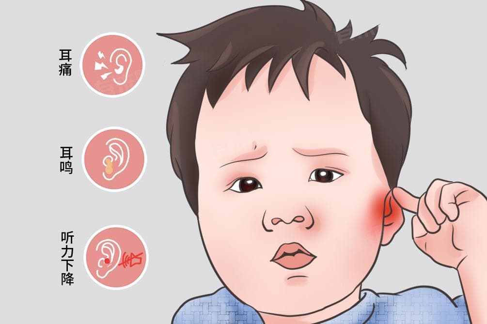分泌性中耳炎治疗要点