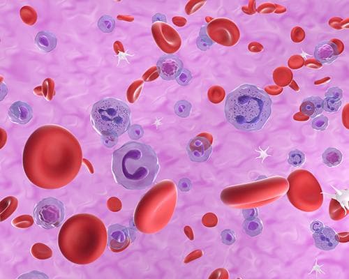 骨髓增生异常综合征：定义、类型、风险因素与诊断