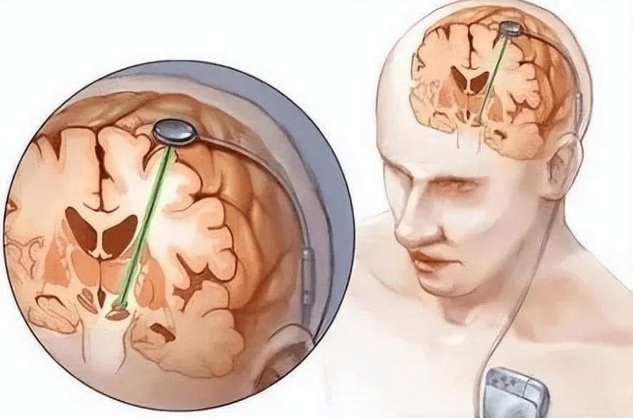 做脑起搏器手术（DBS）有哪些要求？所有帕金森病患者都可以做吗？