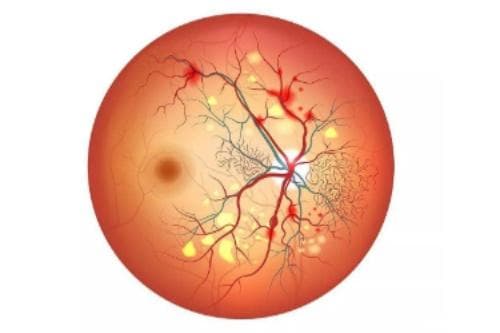 视网膜色素变性新突破：基因治疗带来光明希望