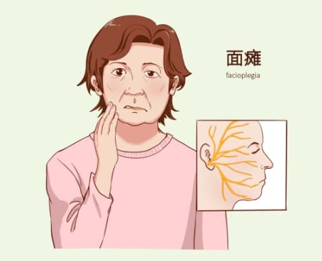警惕流口水：中风与面瘫的信号