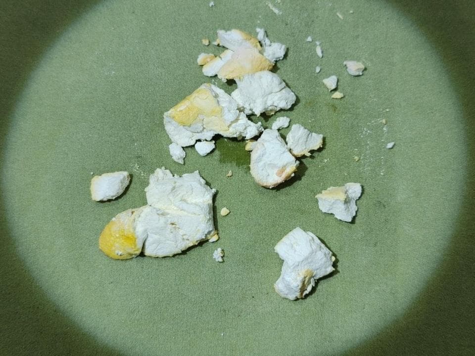 爱吃油炸食物，“快乐水”成升喝，中年男胆囊内长出巨型结石
