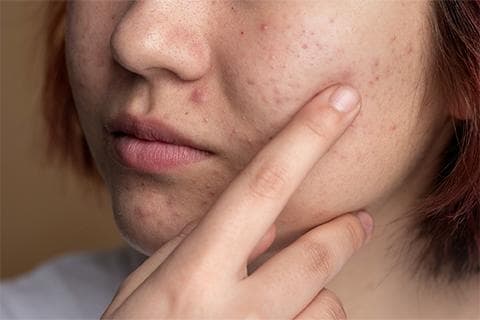 中医治疗痤疮：原理、方法与适用人群
