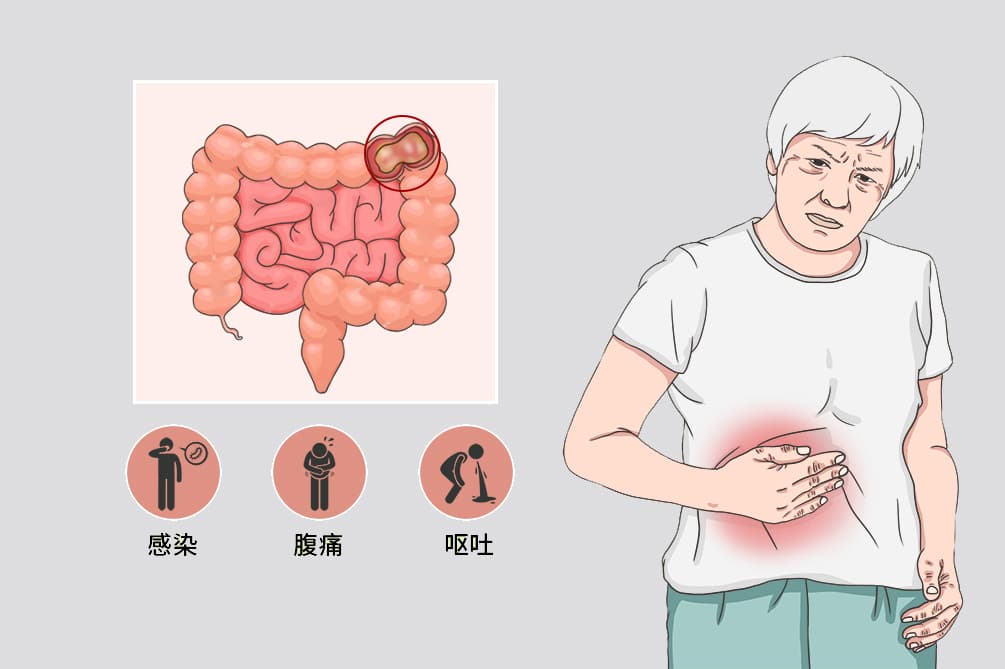 麻痹性肠梗阻