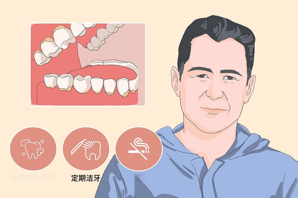 牙结石怎么去除最快最干净