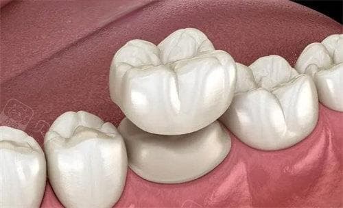 戴牙冠后的常见不适症状及应对方法