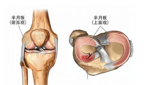 半月板手术费用及报销指南：从手术到康复全过程详解