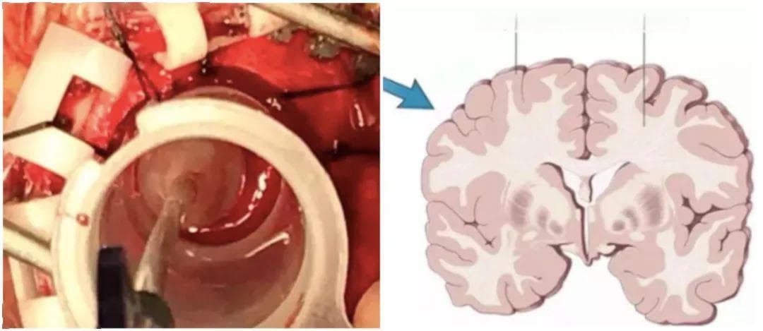 脑出血手术治疗时机的选择