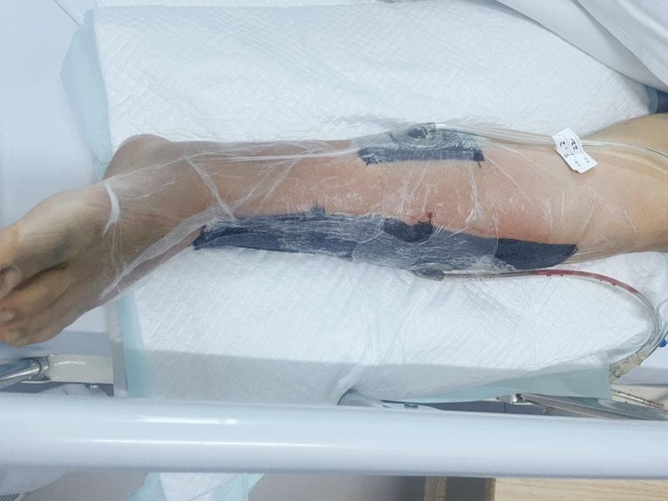 女子破皮后喷云南白药“疗伤”致皮肤坏死渗出脓液……处理外伤有两大误区