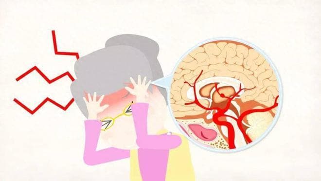 中风后日常如何饮食？医生提示：饮食注意这4点，千万别乱吃！