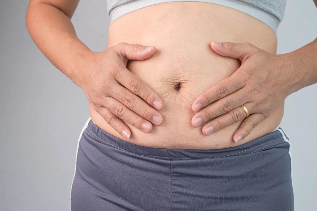 产后肚子有个条状隆起、皮肤松弛？可能是腹直肌分离！