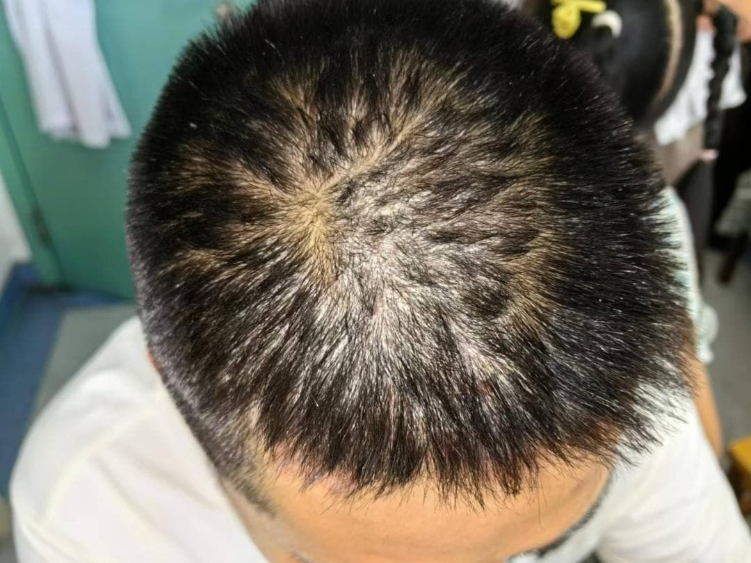 世界银屑病日：揭开银屑病(牛皮癣)的神秘面纱