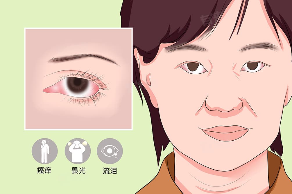 如何预防红眼病传染病