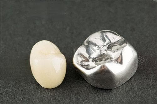 镶牙用什么材质好？四种常见镶牙材质特点、优缺点及使用情况全解析
