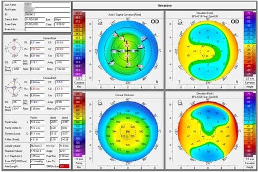 近视手术新选择：个性化全激光SMART手术详解