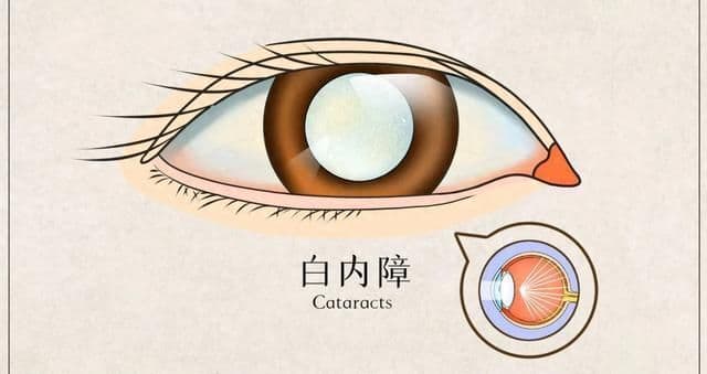 治疗白内障的常用眼药水有哪些？
