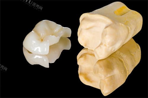 牙齿大面积龋坏别着急拔，嵌体修复还您健康好牙