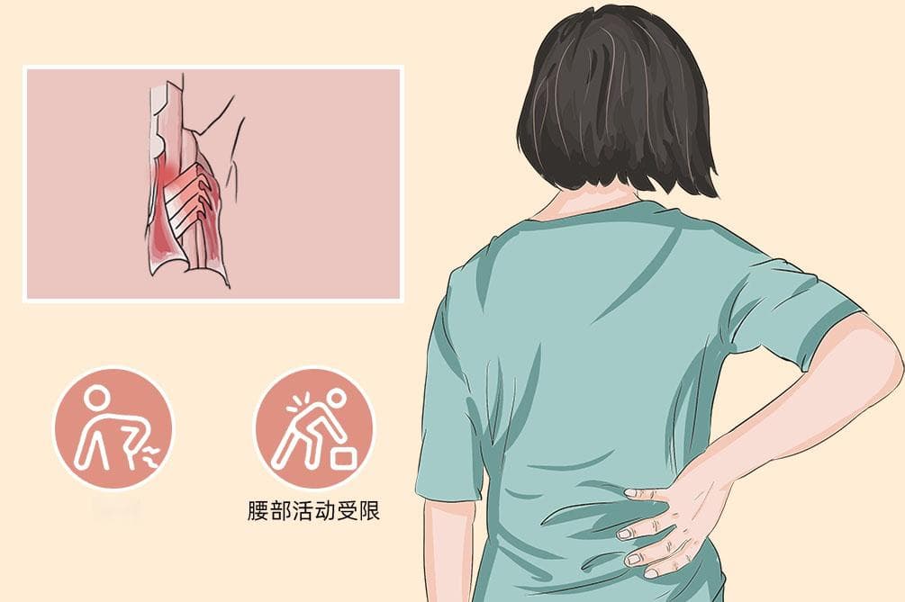 腰肌劳损的康复训练