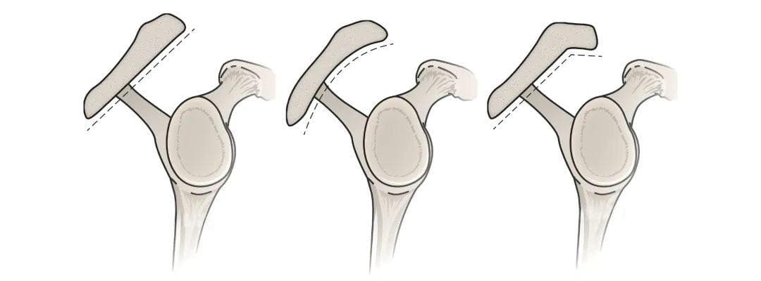 第二肩关节：解剖结构、功能及临床意义