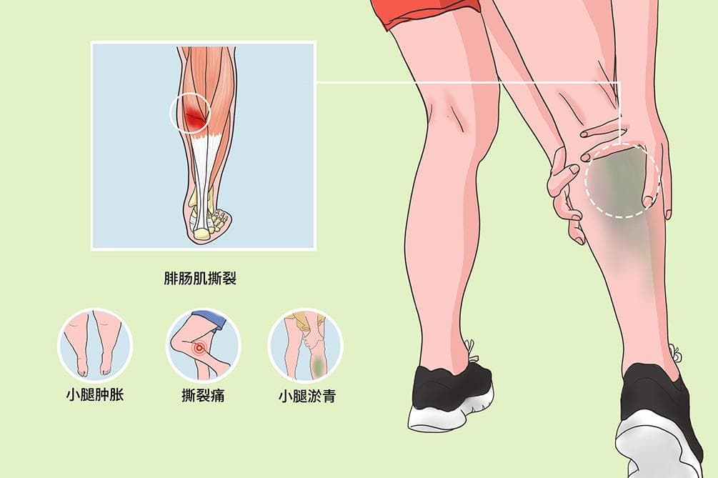 腓肠肌撕裂：症状、诊断与治疗全解析