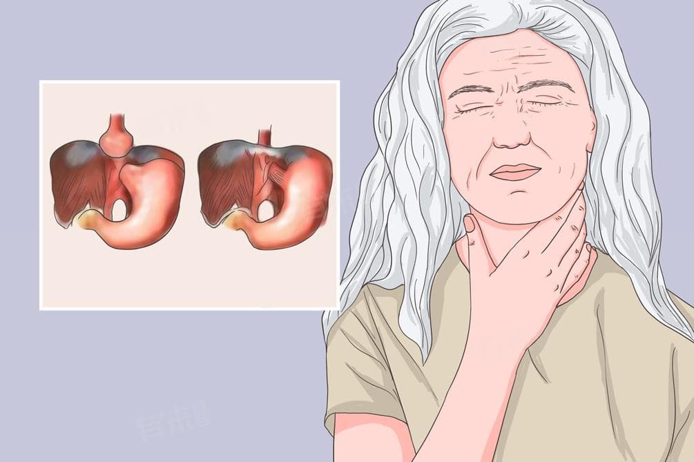 什么是食管裂孔疝