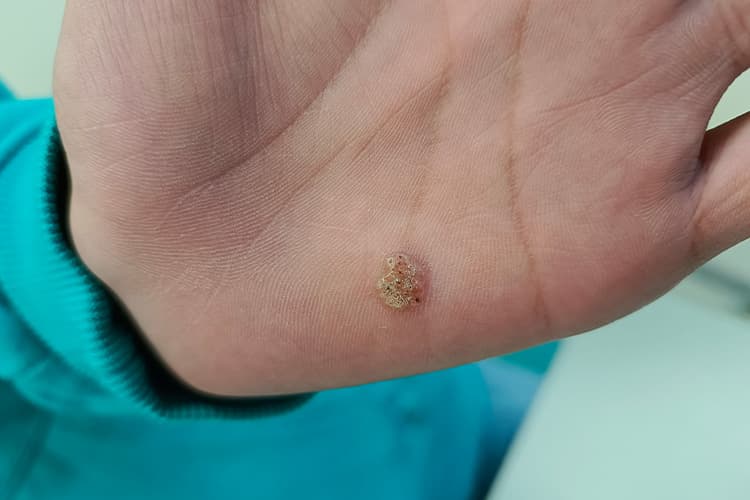 手上出现凸起硬疙瘩怎么办？可能病因及处理方法