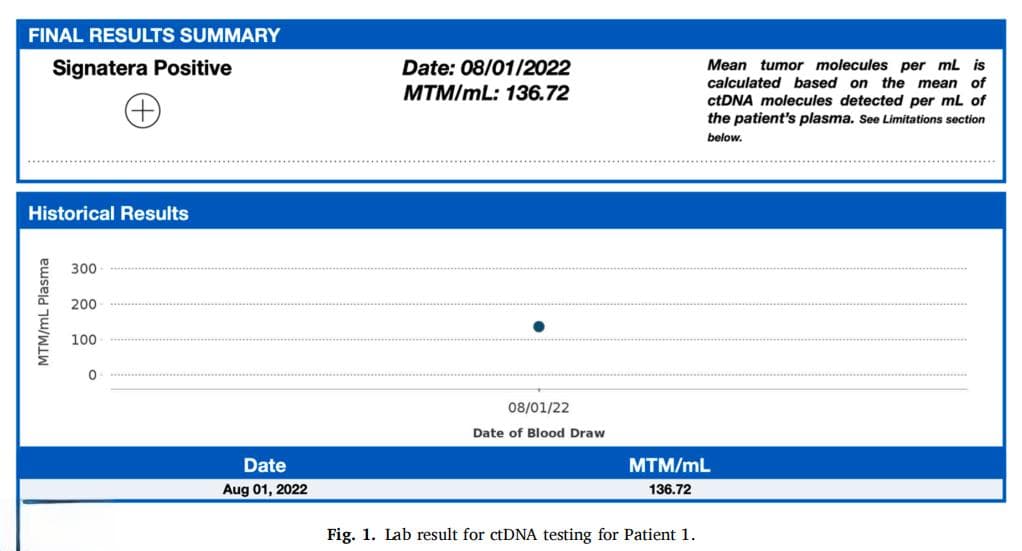 临床实例，早期高风险乳腺癌放疗后应用ctDNA MRD监测效果如何？