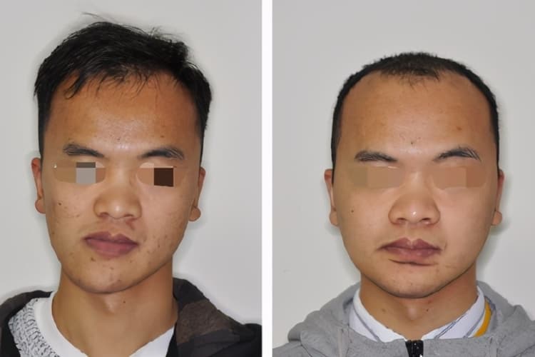 面部不对称脸歪的原因及改善方法