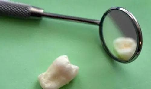 拔智齿磨的是骨头不是牙？遇到这4种类型的智齿，需及时就医拔除