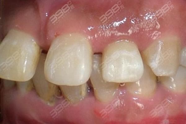 牙齿断一半的是用树脂还是牙冠修复?门牙美学补牙这样做很实惠